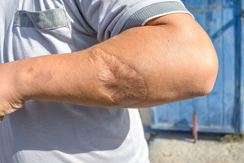 What Should I Do If a Dog Bite Leaves Permanent Scars?